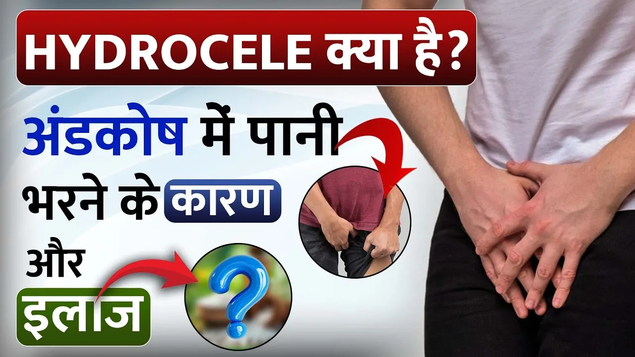 Hydrocele In Hindi Meaning: अंडकोष में पानी भरने के कारण, लक्षण और नवीनतम उपचार