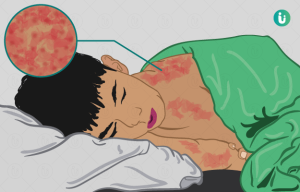 measles meaning in hindi 3