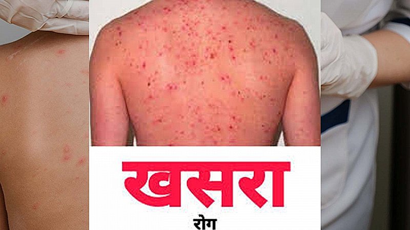 खसरा कैसे फैलता है? (खसरा संक्रमण: संचरण का तरीका)