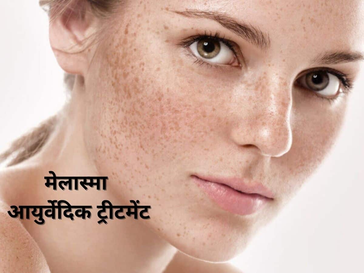 मेलास्मा का हिंदी में अर्थ: परिभाषा और बुनियादी बातें (Melasma ka Hindi mein arth: Paribhasha aur buniyadi baatein)