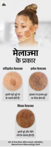 melasma meaning in hindi 2