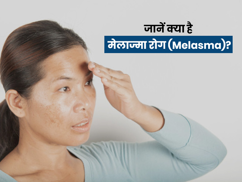 मेलास्मा के कारण और जोखिम कारक: हिंदी में व्याख्या (Melasma ke karan aur jokhim karak: Hindi mein vyakhya)