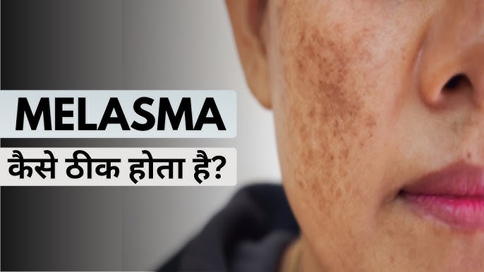 मेलास्मा का निदान: हिंदी में जानकारी (Melasma ka nidan: Hindi mein jankari)