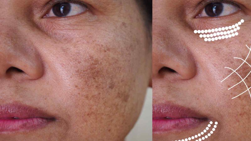 मेलास्मा का उपचार: हिंदी में उपाय और विकल्प (Melasma ka upchar: Hindi mein upay aur vikalp)