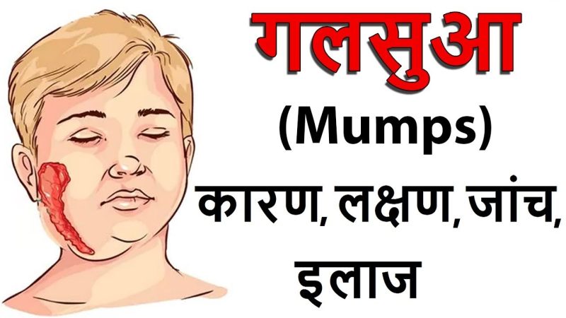 गलसुआ के कारण और जोखिम कारक: हिंदी में जानकारी  Causes and Risk Factors of Mumps: Information in Hindi