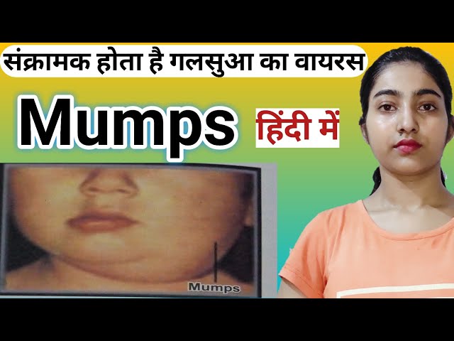 गलसुआ का निदान: हिंदी में परीक्षण और प्रक्रियाएँ  Mumps Diagnosis: Tests and Procedures in Hindi