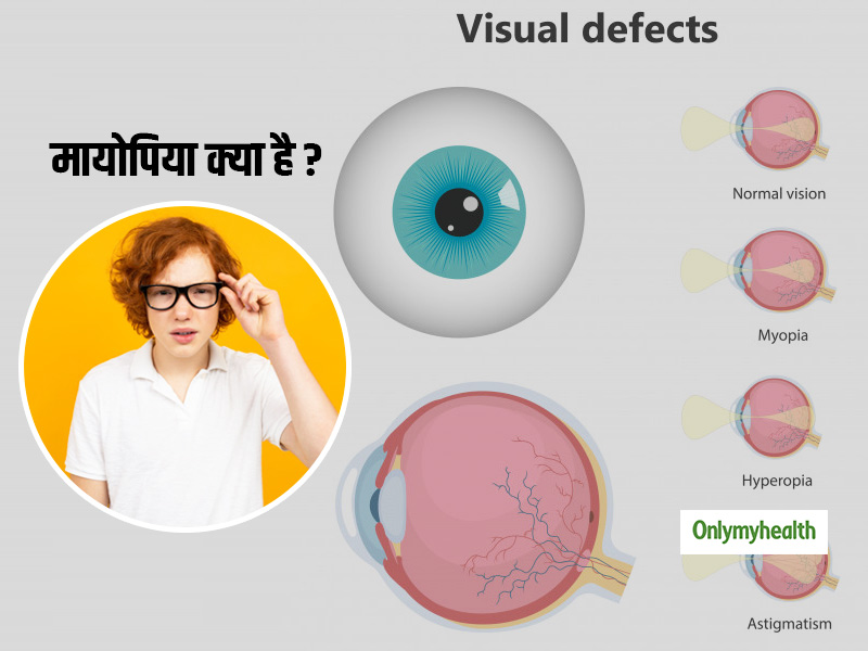 मायोपिया के कारण: हिंदी में स्पष्टीकरण (Myopia ke karan: Hindi mein spashtikaran)
