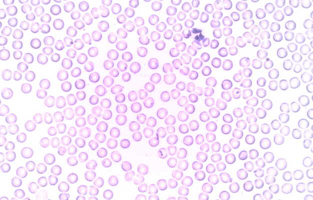 न्यूट्रोफिल काउंट को समझना: उच्च और निम्न स्तर (Neutrophil Count Ko Samajhna: Uchch Aur Nimn Star)