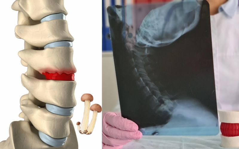 osteophytes meaning in hindi - Hình 3