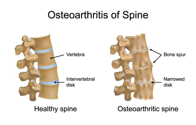 osteophytes meaning in hindi - Hình 4