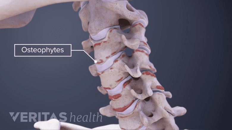 osteophytes meaning in hindi - Hình 5