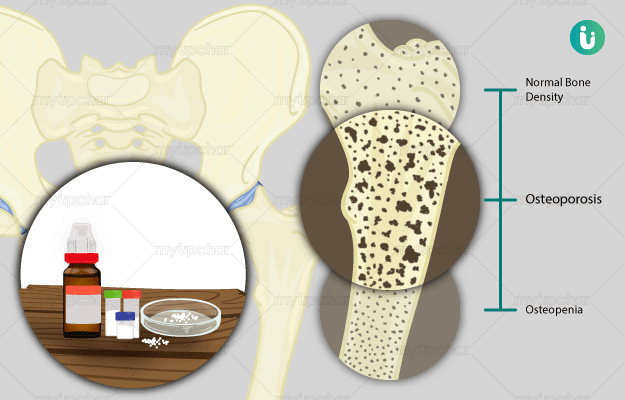 ऑस्टियोपोरोसिस का हिंदी अर्थ (Osteoporosis Ka Hindi Arth)