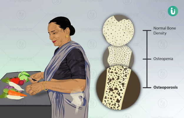 ऑस्टियोपोरोसिस के लक्षण (Osteoporosis Ke Lakshan)
