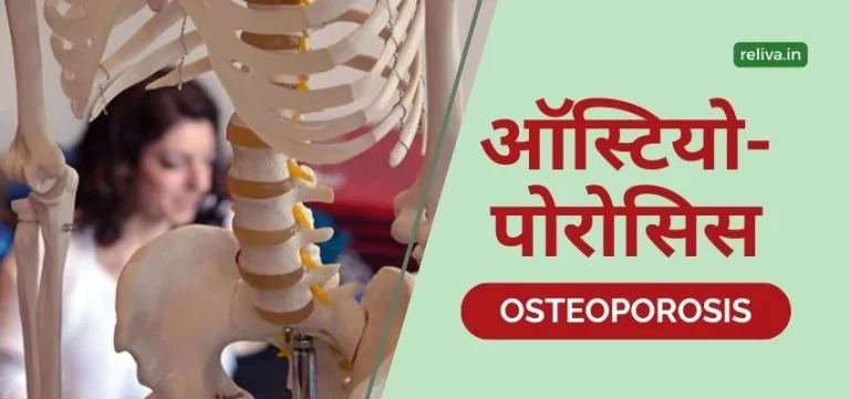 ऑस्टियोपोरोसिस का इलाज (Osteoporosis Ka Ilaj)