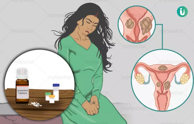 Ovarian Cyst In Hindi Meaning: अंडाशय पुटी (ओवेरियन सिस्ट) का संपूर्ण परिचय और उपचार