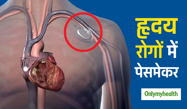 pacemaker meaning in hindi - Hình 2