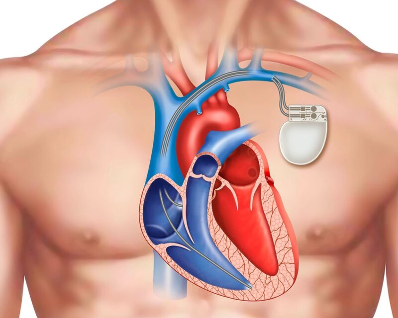 pacemaker meaning in hindi - Hình 3