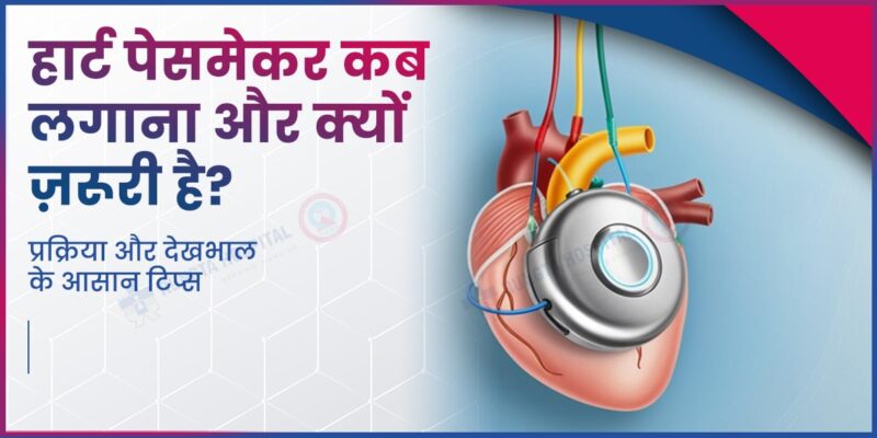 pacemaker meaning in hindi - Hình 4