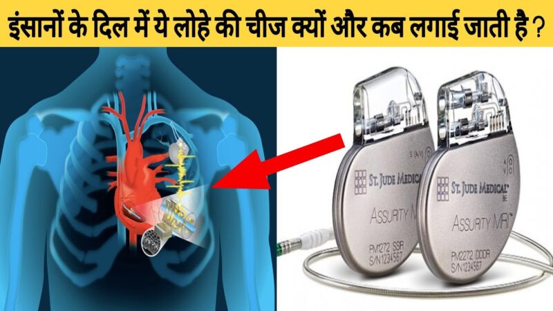 pacemaker meaning in hindi - Hình 5