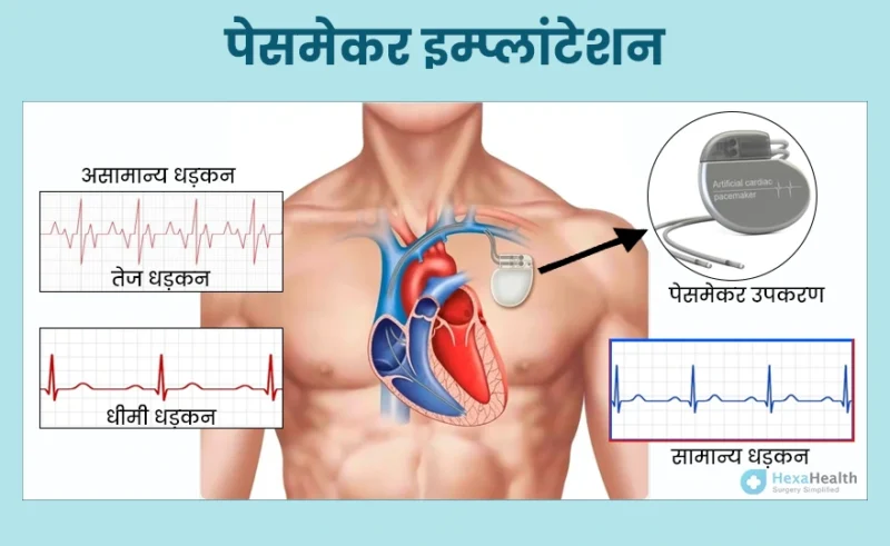 pacemaker meaning in hindi - Hình 1