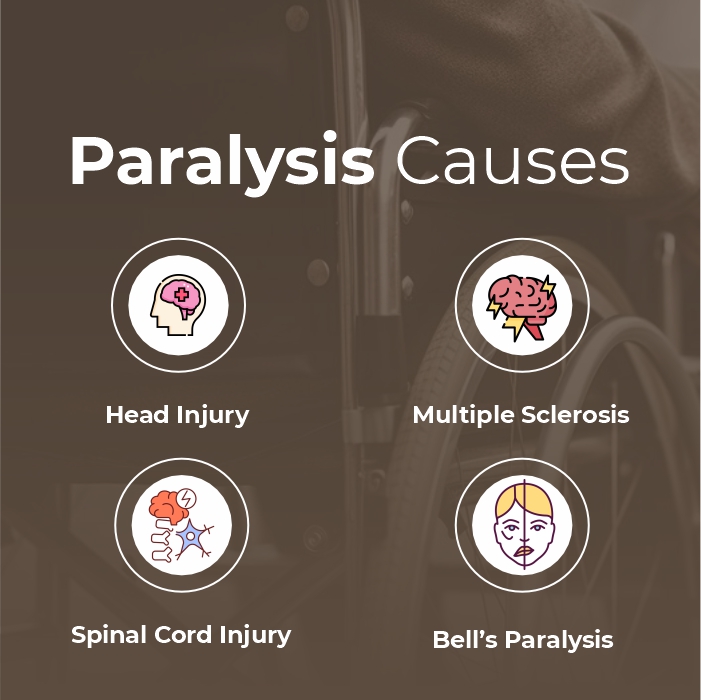 पक्षाघात का अर्थ (Paralysis Meaning): परिभाषा और प्रकार  पक्षाघात क्या है, इसके विभिन्न प्रकार क्या हैं? यह शरीर को कैसे प्रभावित करता है?