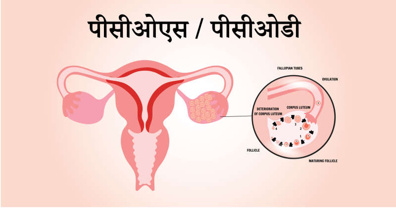 पीसीओएस के मुख्य लक्षण क्या हैं? (हिंदी में पीसीओएस के सामान्य लक्षणों की जानकारी)