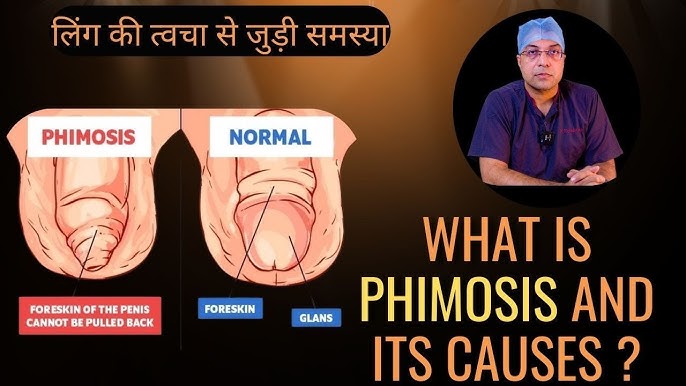 फिमोसिस के कारण (Phimosis Ke Karan)