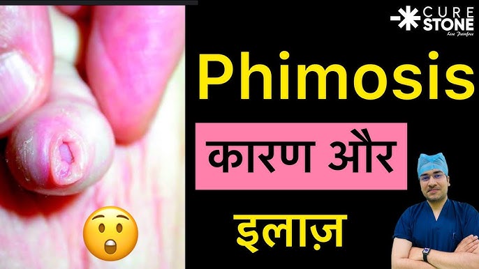 फिमोसिस के लक्षण और पहचान (Phimosis Ke Lakshan Aur Pehchan)