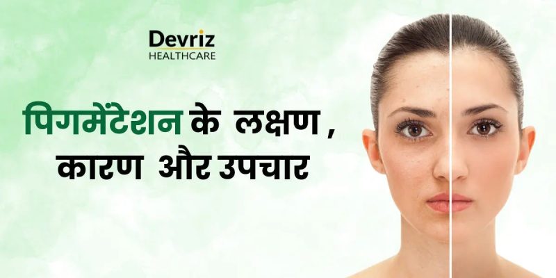 त्वचा पर पिगमेंटेशन के प्रकार: कारण, लक्षण और चित्र