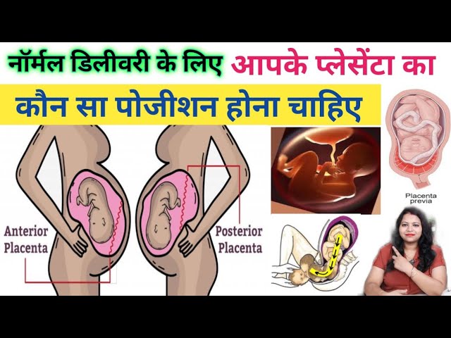 प्लेसेंटा पोस्टीरियर के संभावित जोखिम और जटिलताएँ  प्लेसेंटा पोस्टीरियर से जुड़ी संभावित समस्याएं, जैसे प्लेसेंटा प्रेविया और रक्तस्राव, और उनका प्रबंधन कैसे किया जाता है।