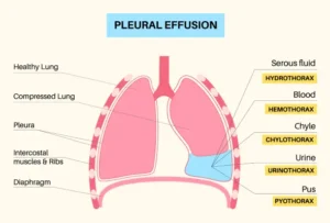 pleural effusion meaning in hindi