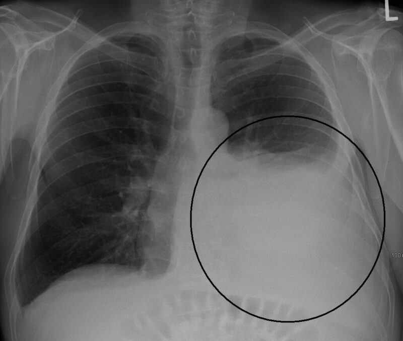 pleural effusion meaning in hindi - Hình 4