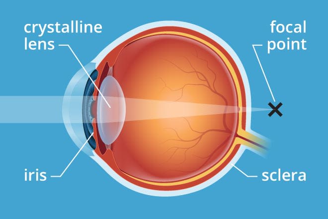 presbyopia meaning in hindi - Hình 1