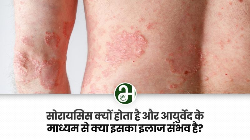 सोरायसिस के कारण: हिंदी में समझ