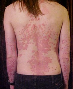 psoriasis meaning in hindi 3