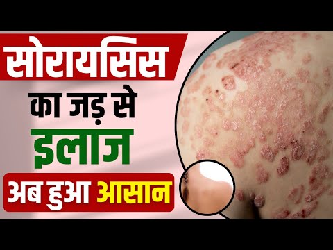 सोरायसिस के उपचार विकल्प: हिंदी में समाधान