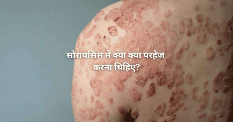 सोरायसिस के साथ जीवन: हिंदी में प्रबंधन और सलाह