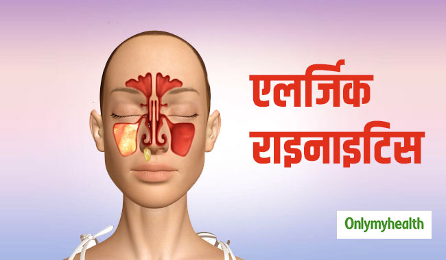 rhinitis meaning in hindi - Hình 3