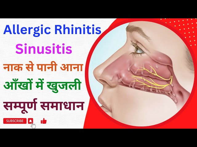 rhinitis meaning in hindi - Hình 4