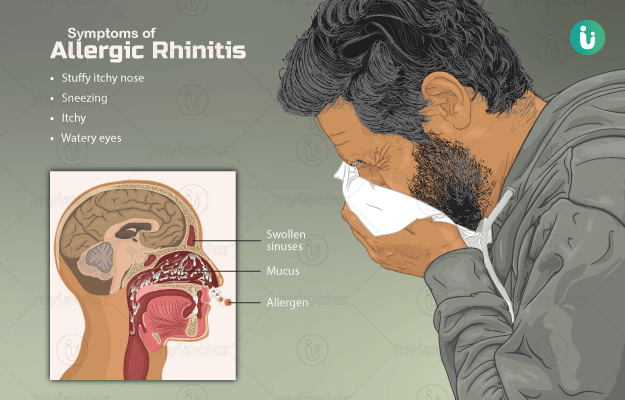 rhinitis meaning in hindi - Hình 1