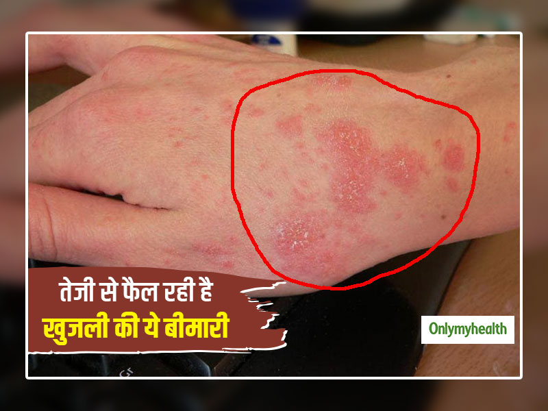 स्कैबीज का हिंदी में अर्थ: परिभाषा, लक्षण और कारण (Scabies ka Hindi mein arth: Paribhasha, lakshan aur karan)