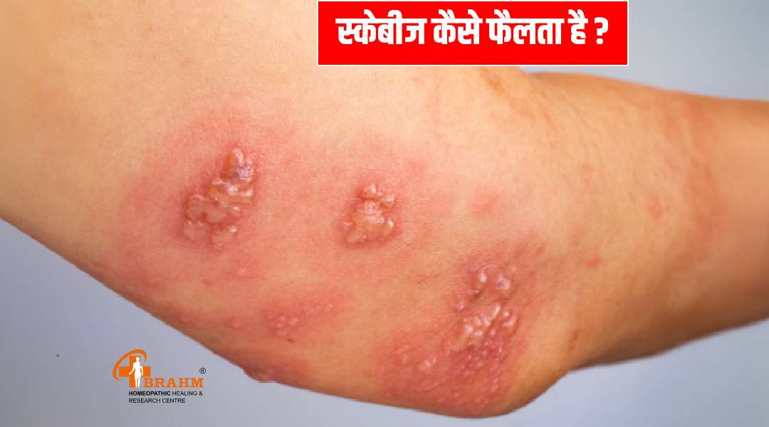 स्कैबीज का निदान: हिंदी में जाँच प्रक्रिया (Scabies ka nidan: Hindi mein jaanch prakriya)