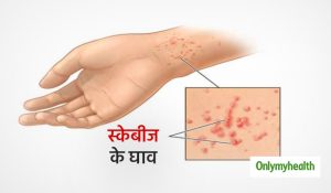 scabies meaning in hindi 5