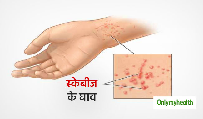 स्कैबीज की रोकथाम: हिंदी में प्रभावी उपाय (Scabies ki roktham: Hindi mein prabhavi upaay)