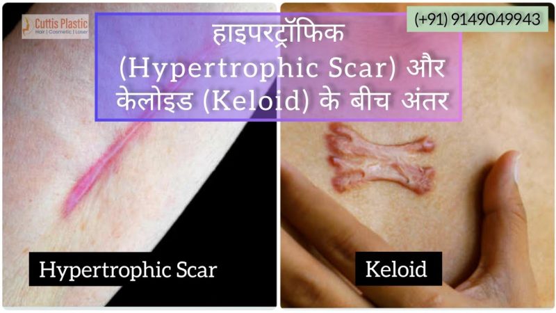 scars meaning in hindi 1