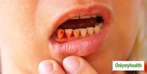 scurvy meaning in hindi 6