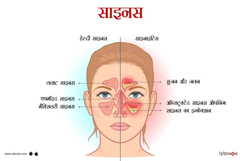 साइनस के प्रकार: हिंदी में पूरी जानकारी
