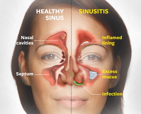 साइनसाइटिस का हिंदी में अर्थ: एक व्यापक समझ (Sinusitis ka Hindi mein arth: Ek vyapak samajh)