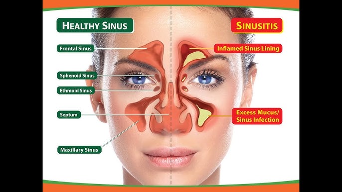 साइनसाइटिस के प्रकार: तीव्र, पुरानी और अन्य (Sinusitis ke prakar: Teevra, puraani aur anya)