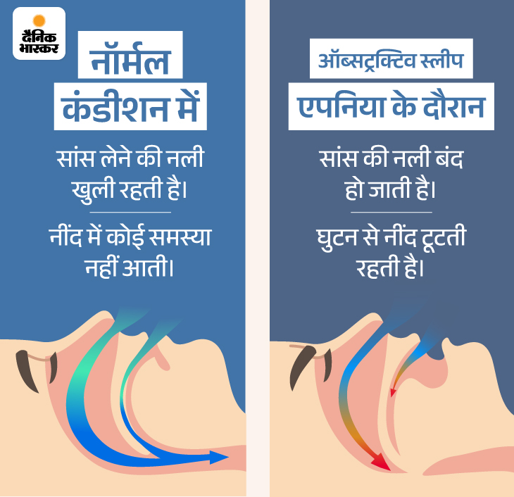 sleep apnea meaning in hindi - Hình 4